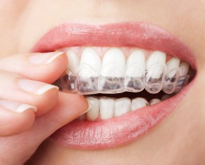 dental whitening kits